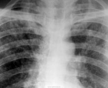 „Am rămas șocat când am aflat că am tuberculoză”. De ce în Moldova oricine se poate îmbolnăvi de TBC