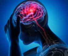 Cercetători din China au găsit un medicament care sporește cu 70% șansele de recuperare după un atac cerebral