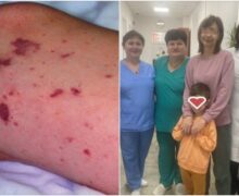 В Кишиневе врачи спасли ребенка с менингитом в тяжелом состоянии. Что надо знать о менингококковой инфекции